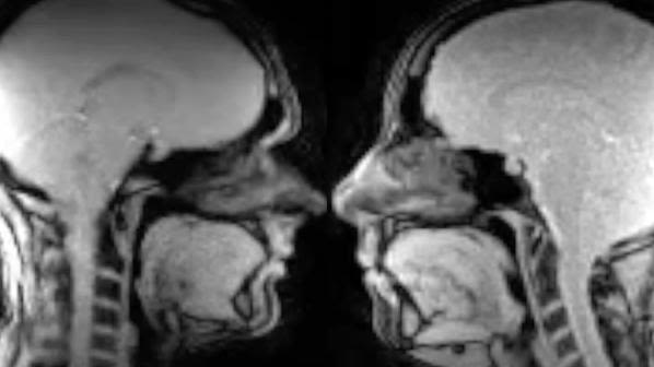 MRI brain scans of two people