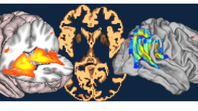 Neuroimaging provides a window into the living brain, and is an increasingly vital experimental medicine tool for neuro-psychiatric disease. With a particular focus on early and pre-clinical disease, we explore how the brain changes before symptoms take hold.